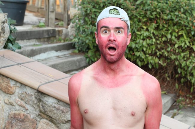 Sunburned,Young,Man,With,Extreme,Tan,Lines